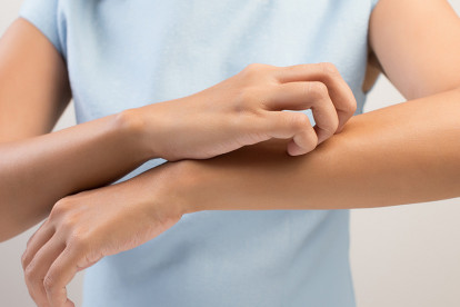 Alergia à picada de mosquito? Saiba o que fazer