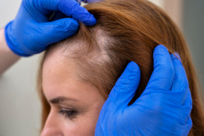 As principais causas e tratamentos para queda de cabelo